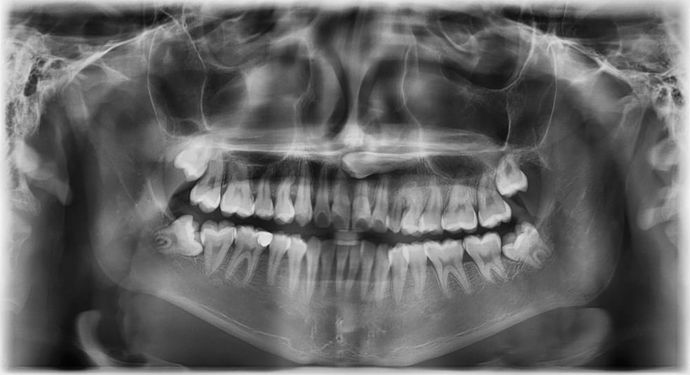 Wisdom Teeth