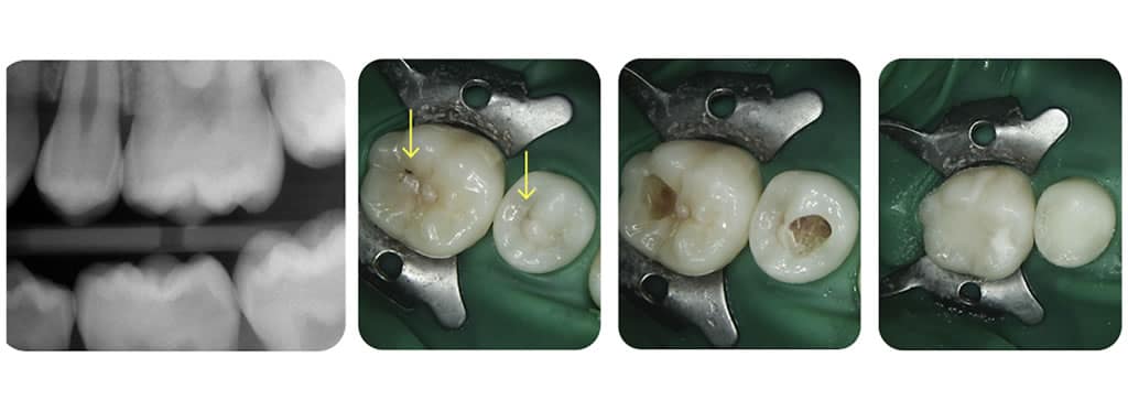 A recent case study on Dental Decay