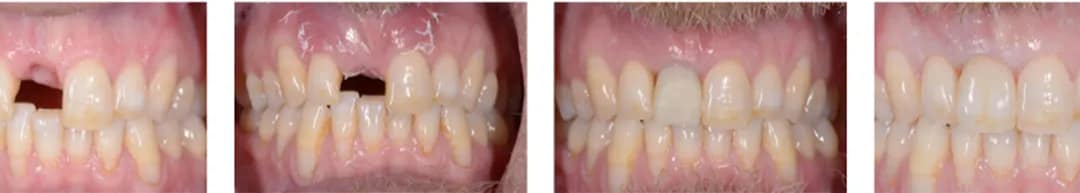 A Recent Case Study on Dental Implants