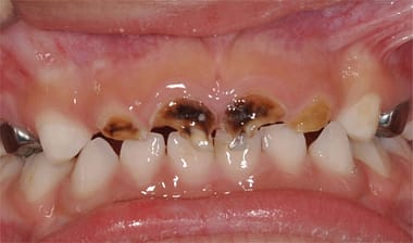 Baby Teeth - Dental Hygiene