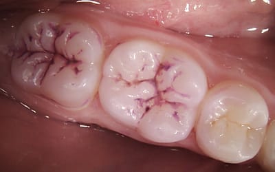Preventing decay with fissure sealants