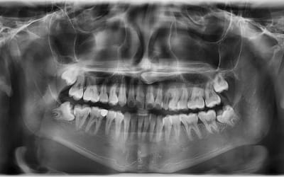 Wisdom Teeth