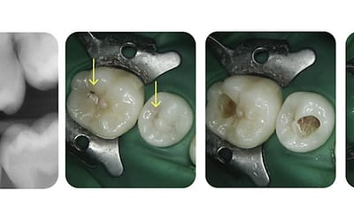 A recent case study on Dental Decay