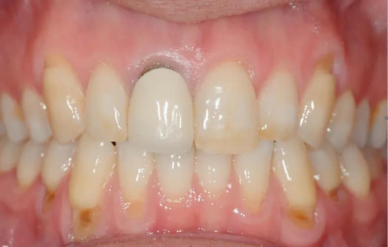 Before Dental implant