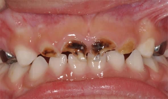 Baby Teeth - Dental Hygiene